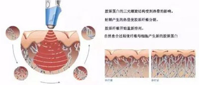 減肥/抗衰兩不誤，BTL溶脂刀儀器一次滿足你
