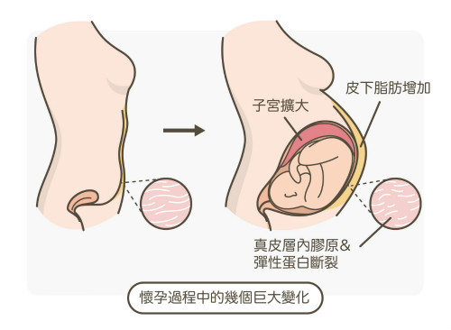 一文秒懂！妊娠紋肥胖紋保養(yǎng)、治療及預(yù)防全攻略