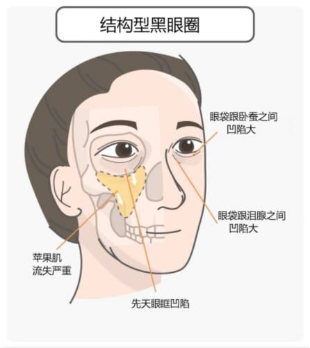 區(qū)分黑眼圈！黑眼圈的成因、分類(lèi)、預(yù)防與治療全攻略