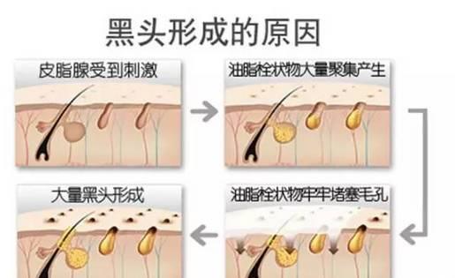 美容儀器廠家教您如何快速祛除黑頭？