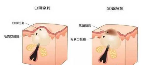 美容儀器廠家教您如何快速祛除黑頭？