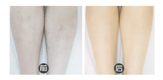 美容儀器脫毛儀在使用中有哪些常見(jiàn)誤區(qū)